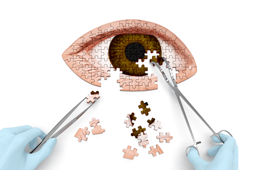 Tracing the Evolution of Refractive Surgeries - Planet Lasik