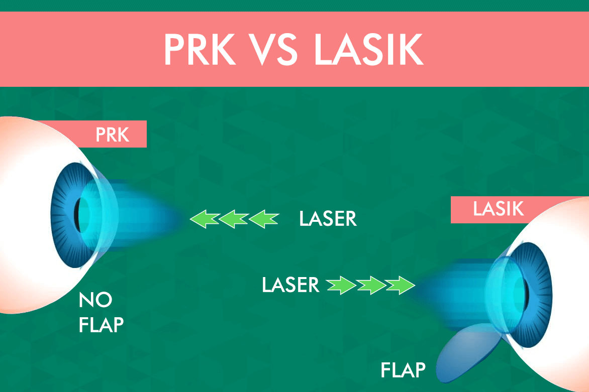 PRK vs LASIK Which Refractive Procedure is Right for You?