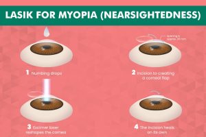 LASIK Eye Surgery for Myopia - Step by Step Procedure