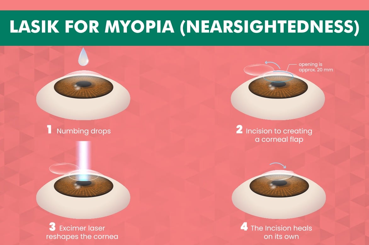 Lasik Surgery for Myopia Nearsightedness Planet Lasik