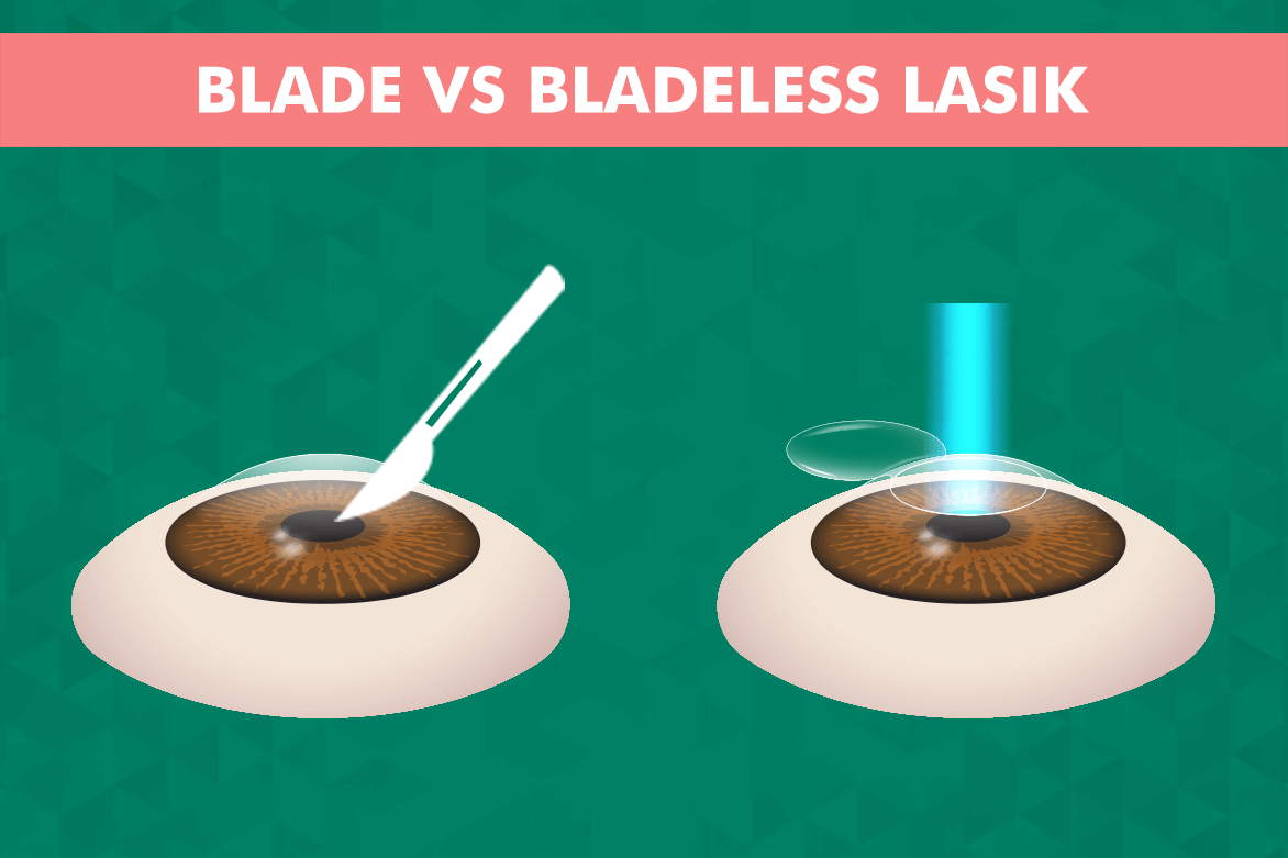 Blade Vs Bladeless Lasik