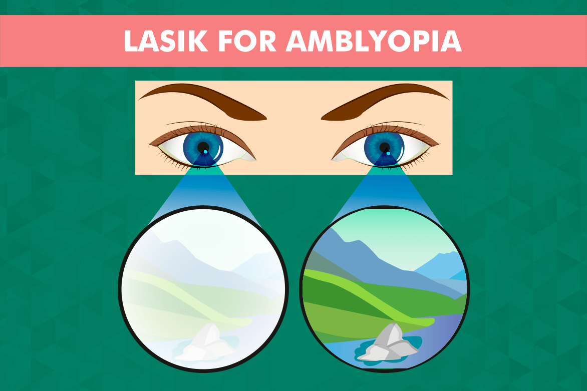 amblyopia surgery