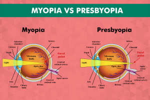 Presbyopia vs. myopia