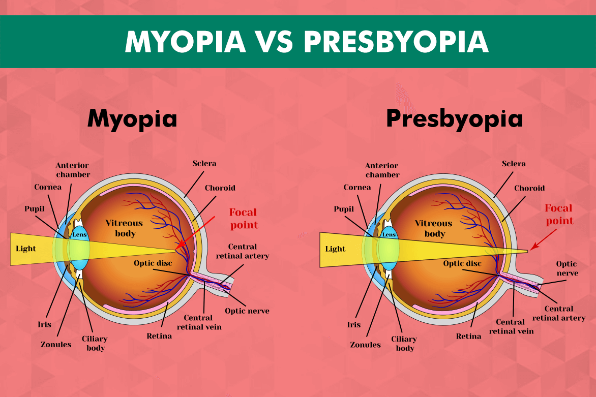 presbyopia vs myopia