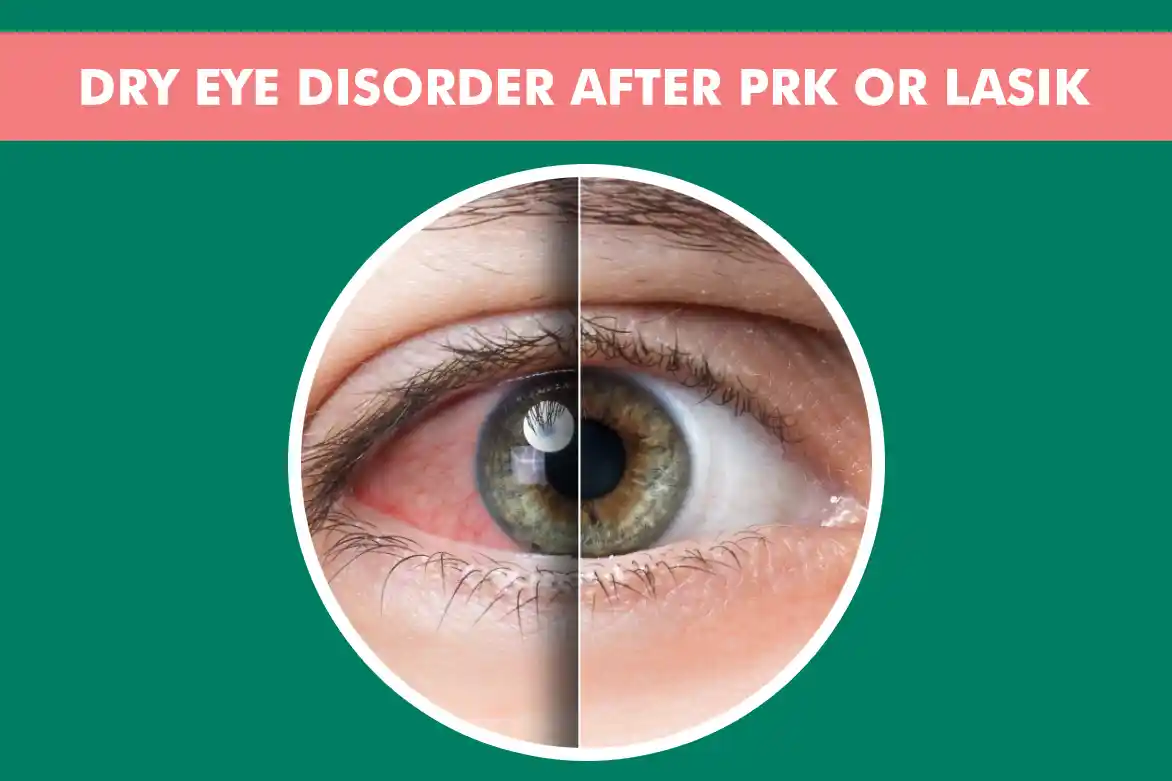 Preventing Dry Eye Disorder After PRK or LASIK Eye Surgery